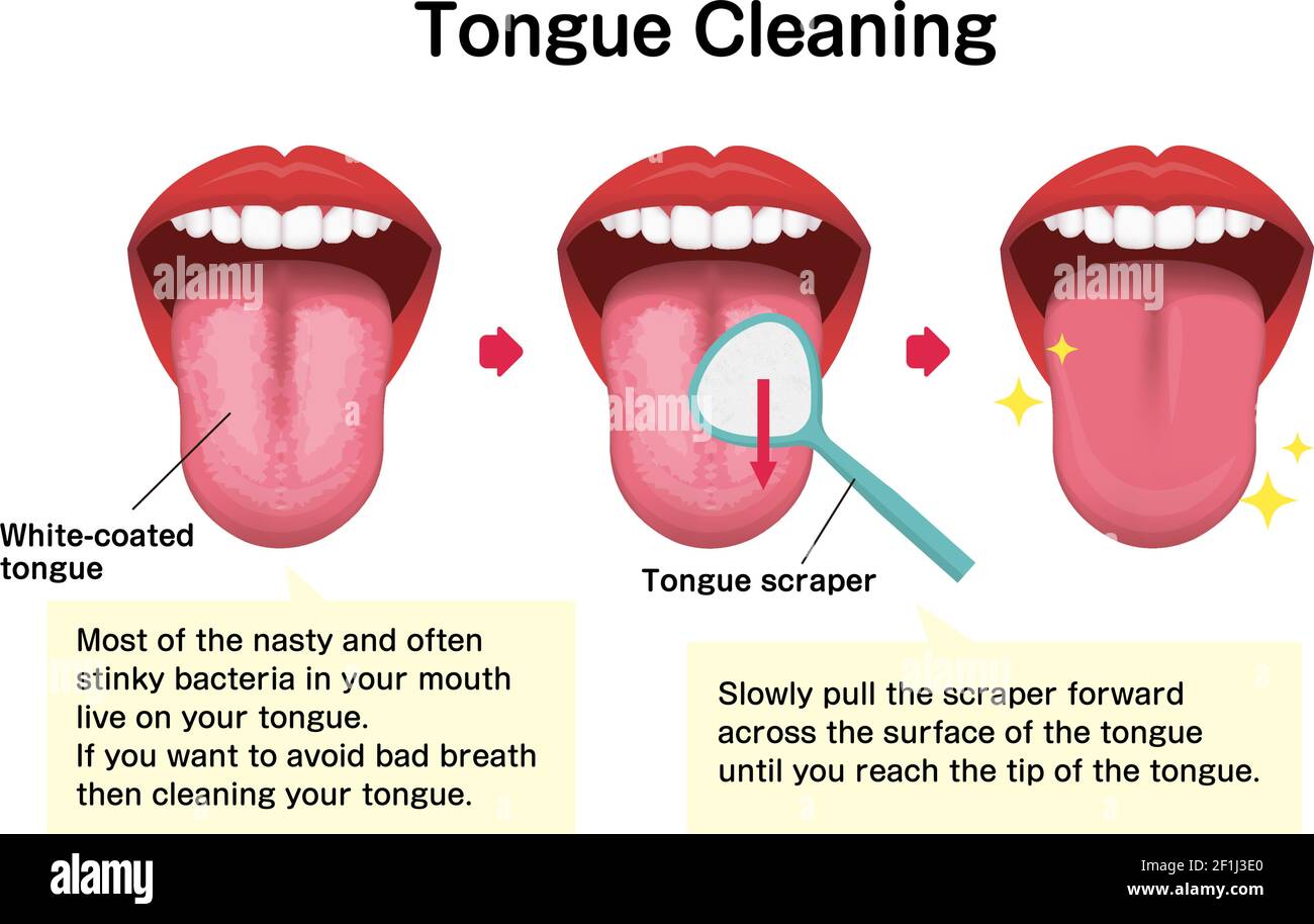 How To Clean Your Tongue Vector Illustration Halitosis Prevention