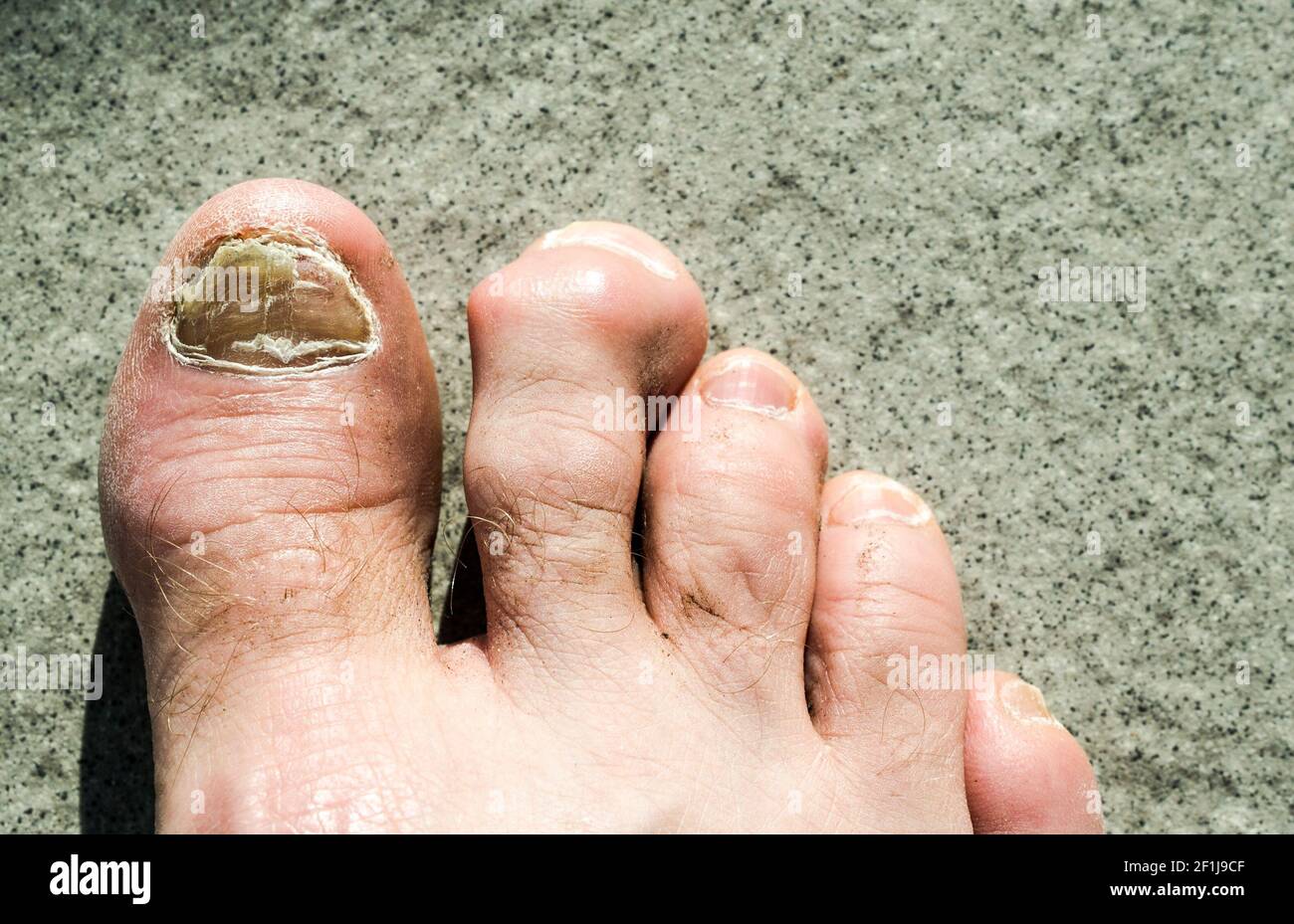 Ugly male feet and toes affected by toe nail fungus and arhtritic hammertoes Stock Photo