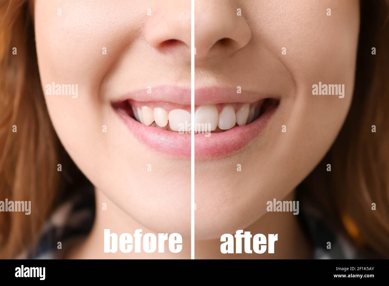 Young woman before and after procedure of gingival plasty, closeup