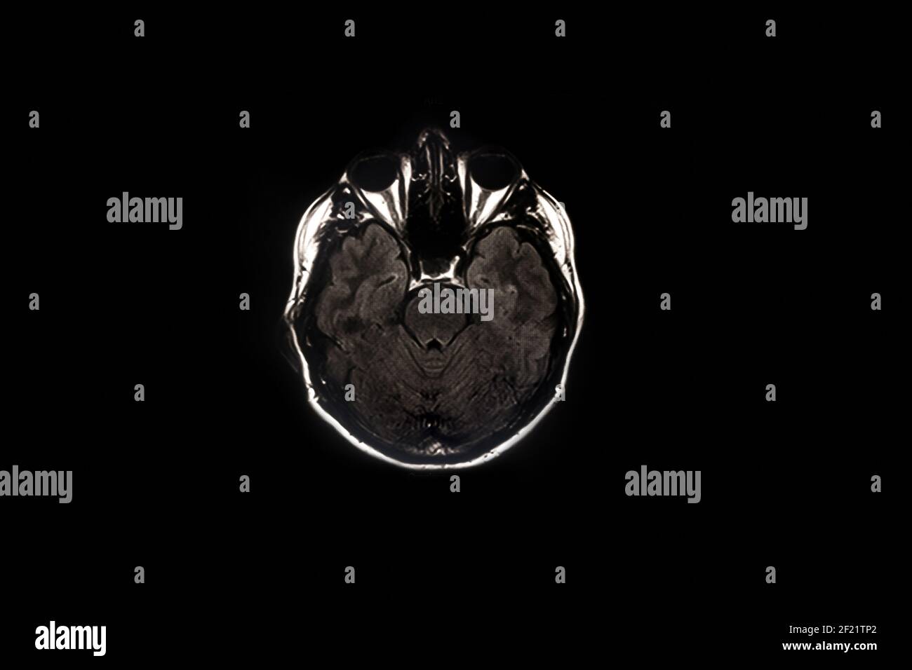 Mri brain scan on skull x ray hi-res stock photography and images - Alamy