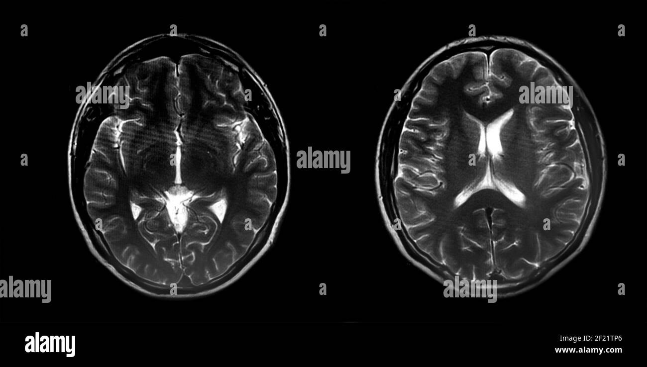 Magnetic resonance image (MRI) of normal brain, panoramic brain tomography Stock Photo