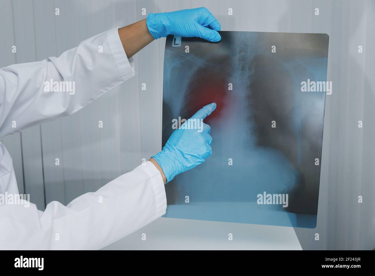 Doctor explaining lungs x-ray film to patiant in the medical office. The film shows symptom of virus or cancer infect patient lung and respiratory org Stock Photo