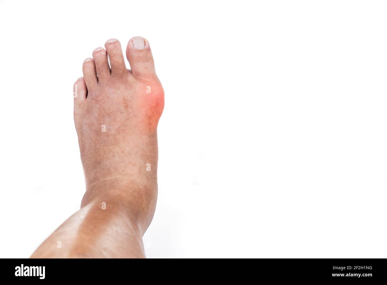 Swollen deformed inflammed toe joint with painful gout Stock Photo