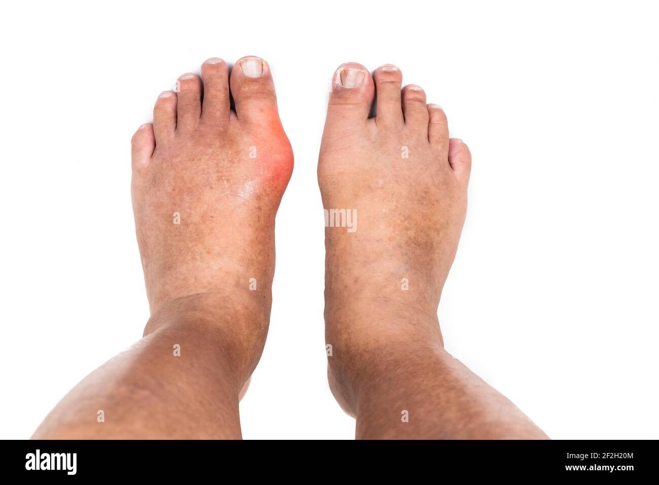 Man with swollen deformed inflammed left foot toe joint with painful gout Stock Photo