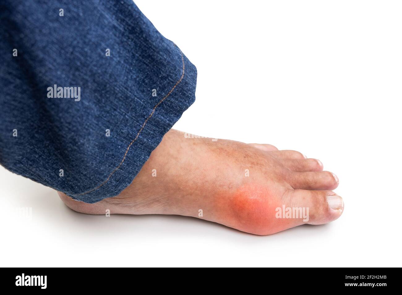 Asian man with swollen deformed inflammed toe joint with painful gout Stock Photo