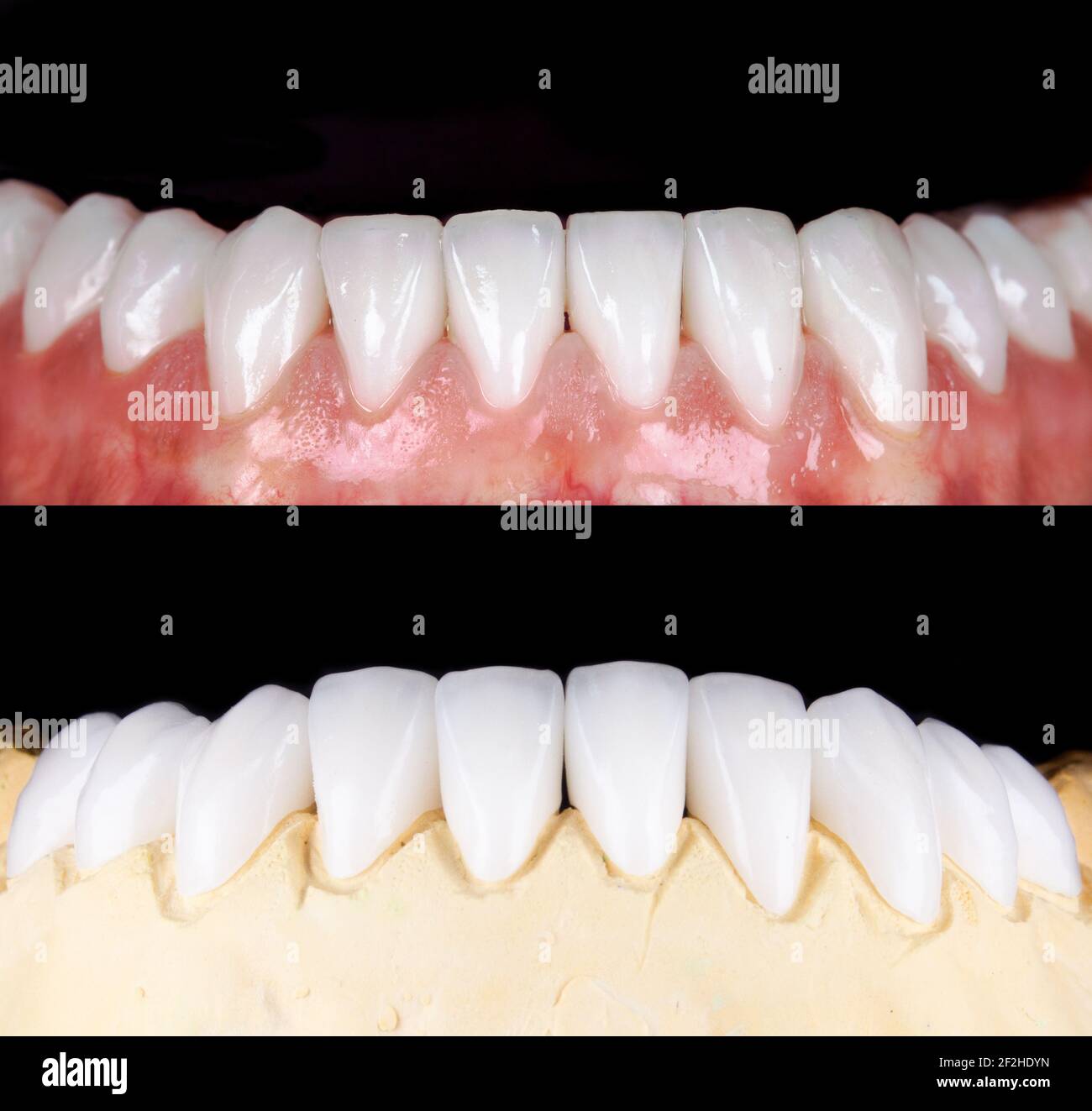 Perfect smile before and after veneers bleach of zircon arch ceramic