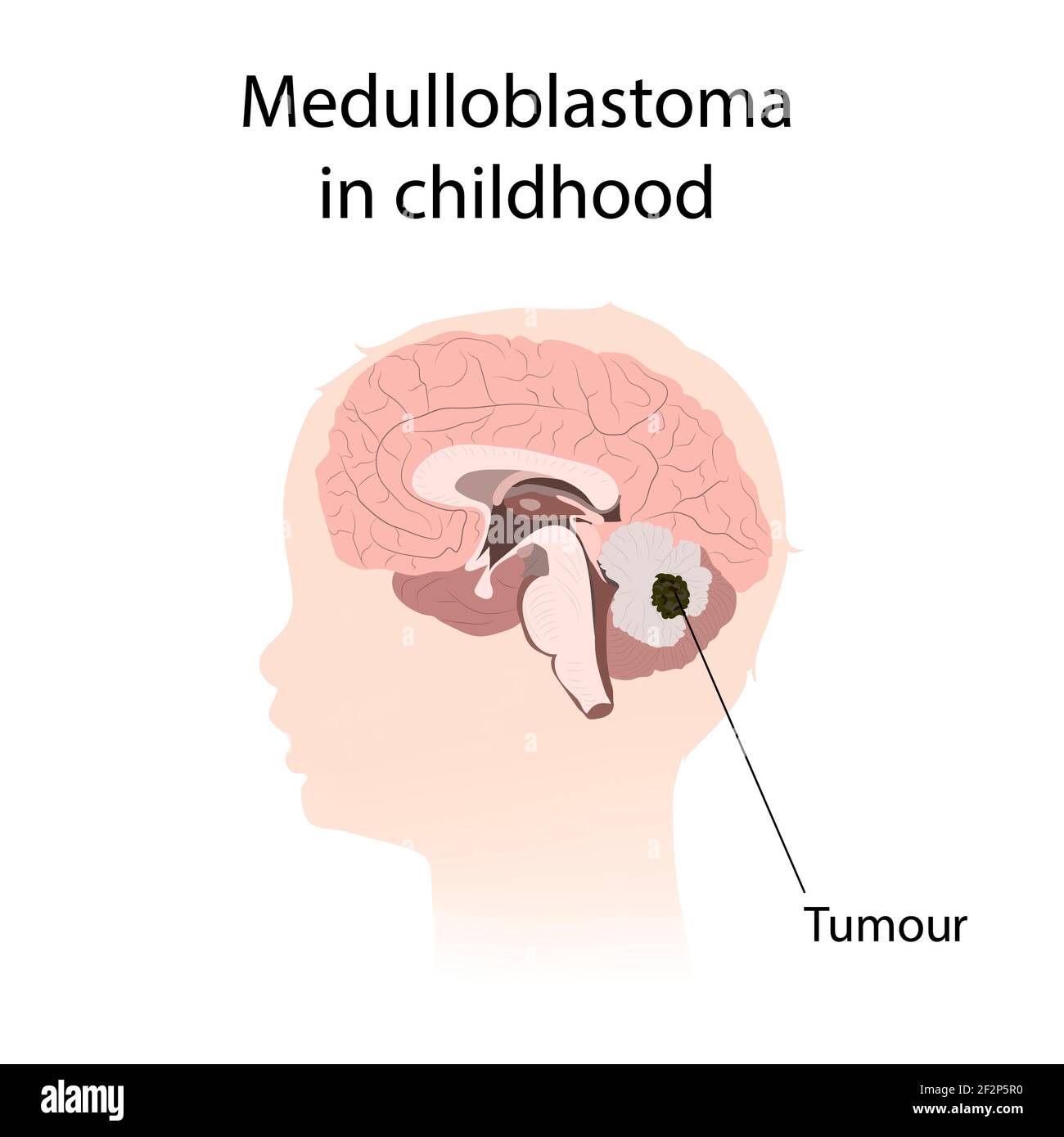 Medulloblastoma in childhood, illustration Stock Photo