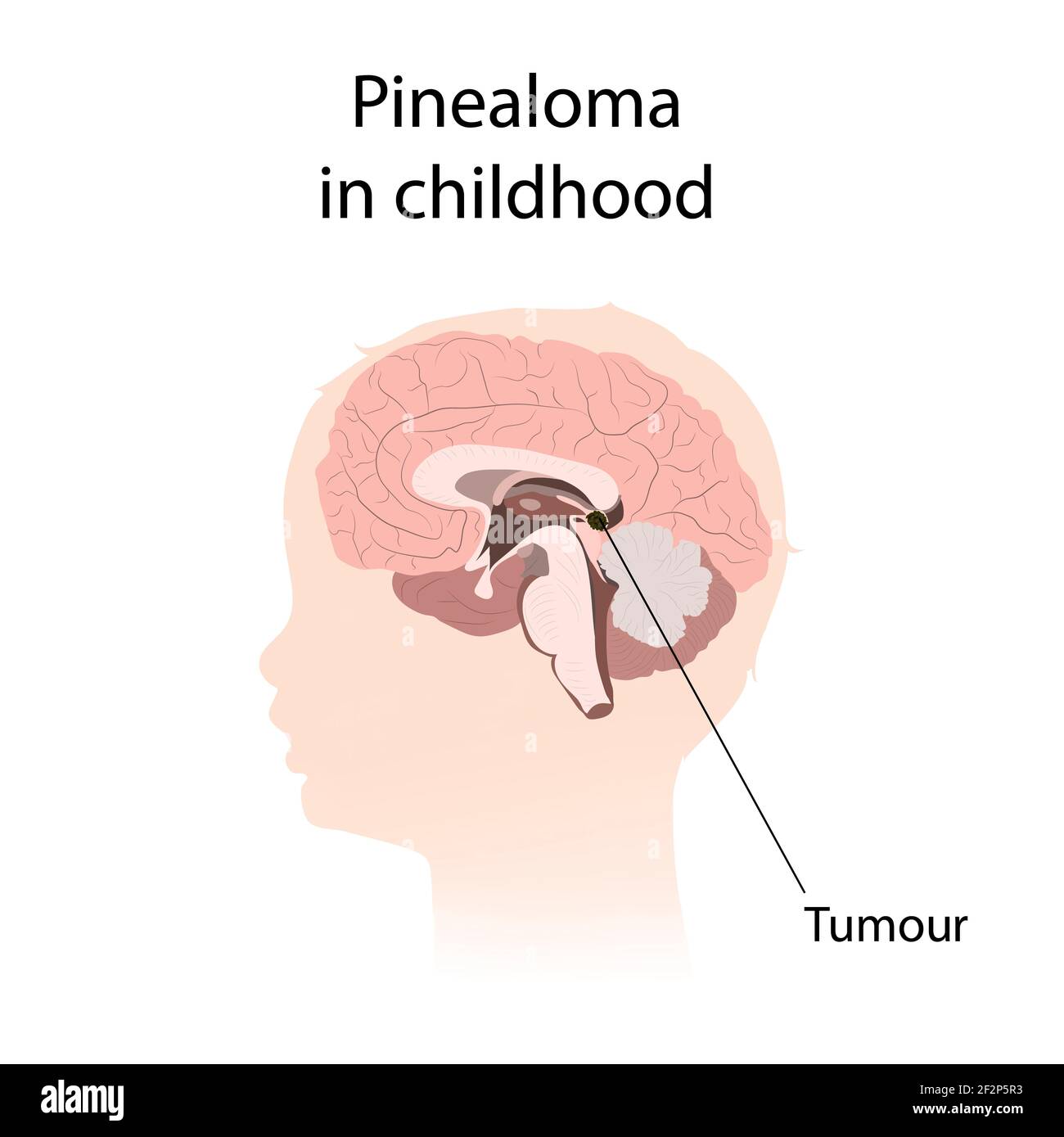 Pinealoma in childhood, illustration Stock Photo