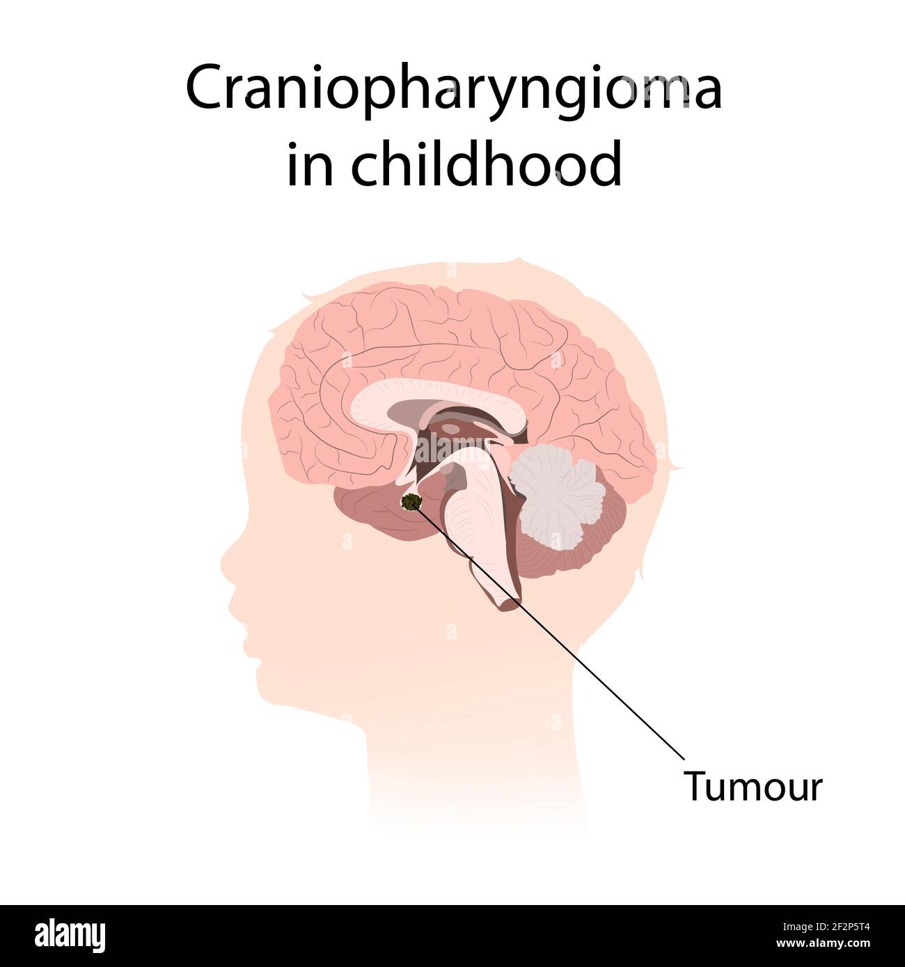 Craniopharyngioma in childhood, illustration Stock Photo