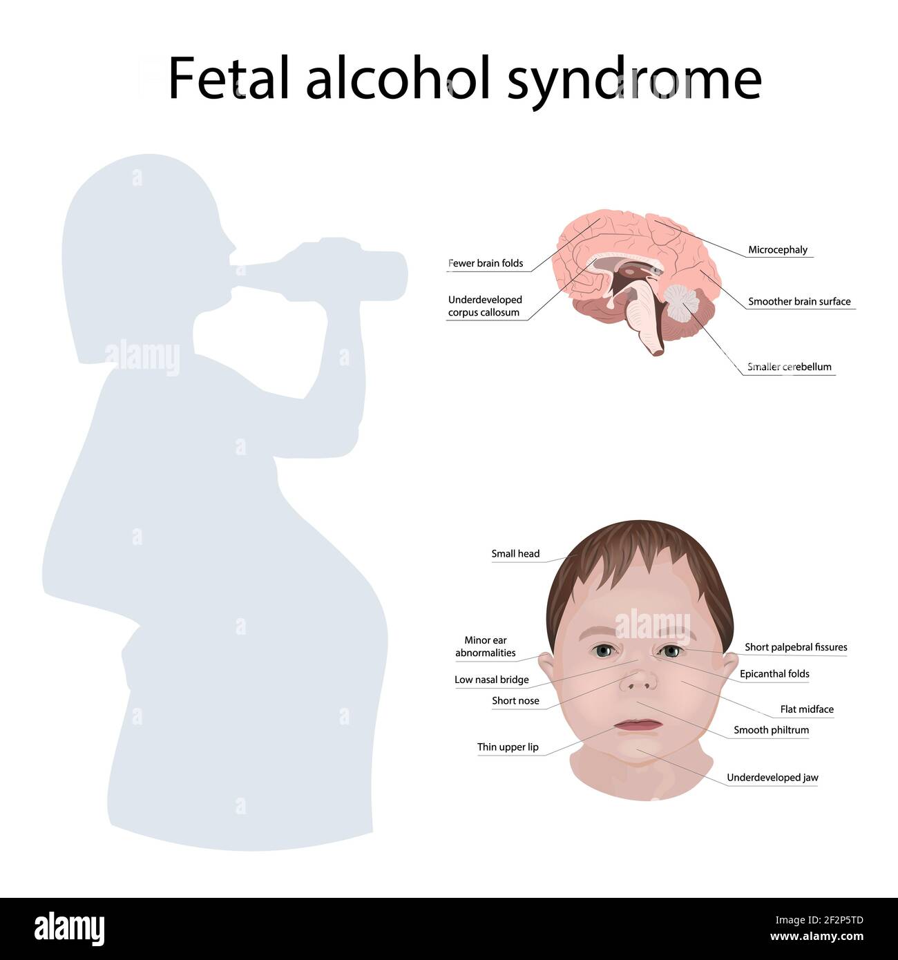Foetal alcohol syndrome hires stock photography and images Alamy