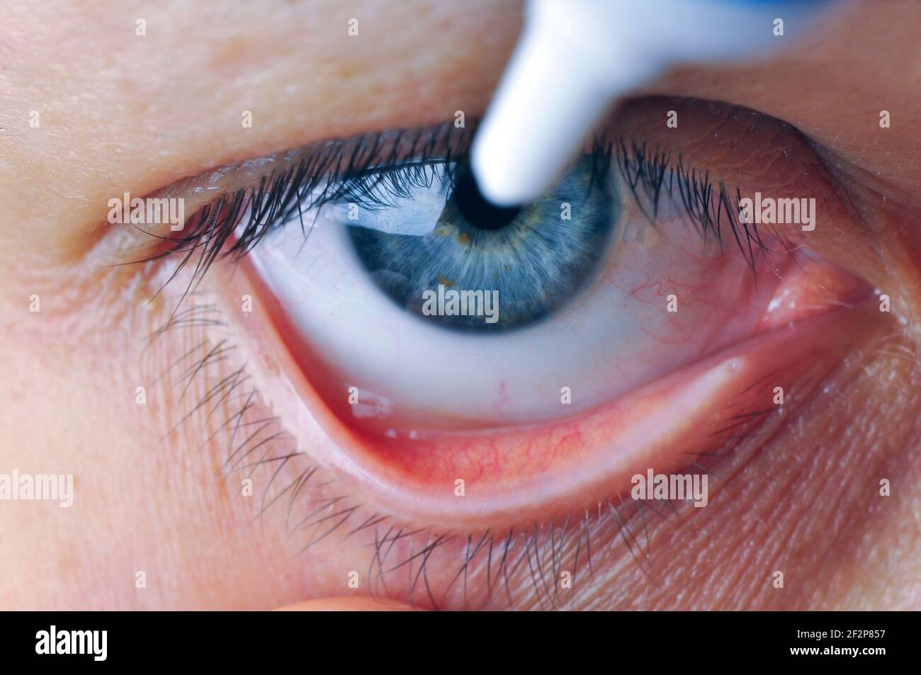 Conjunctival sac hi-res stock photography and images - Alamy