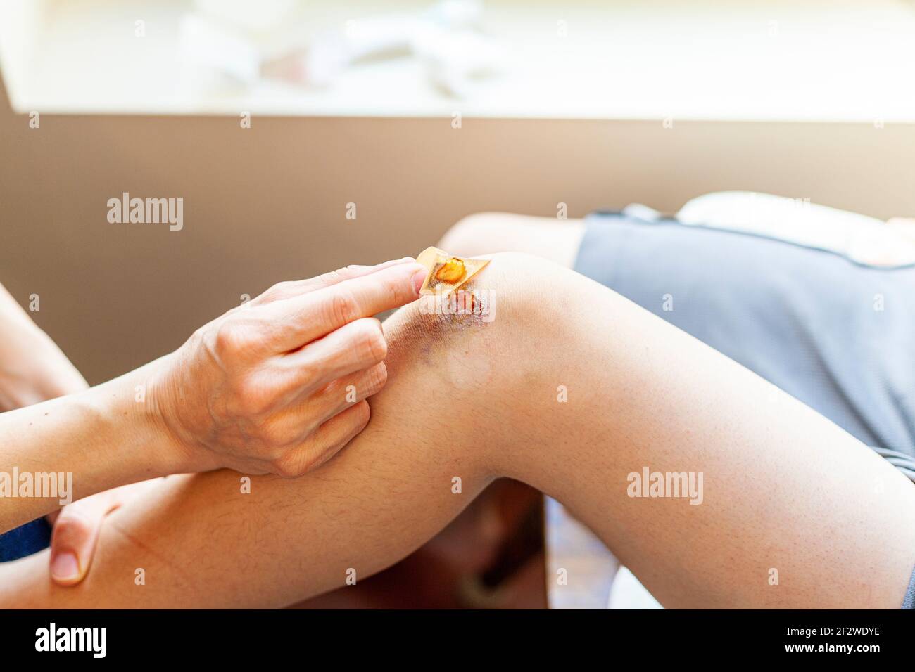 A mother is removing old adhesive bandage antiseptic from the bruised skin over the knee cap of her son. The bruised area has inflammation, tenderness Stock Photo