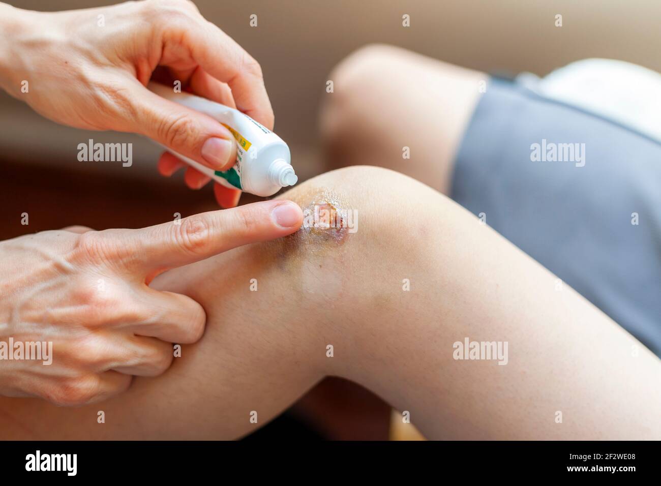A mother is applying topical antiseptic and anti inflammatory cream onto bruised skin over the knee cap of her son. The bruised area has inflammation, Stock Photo