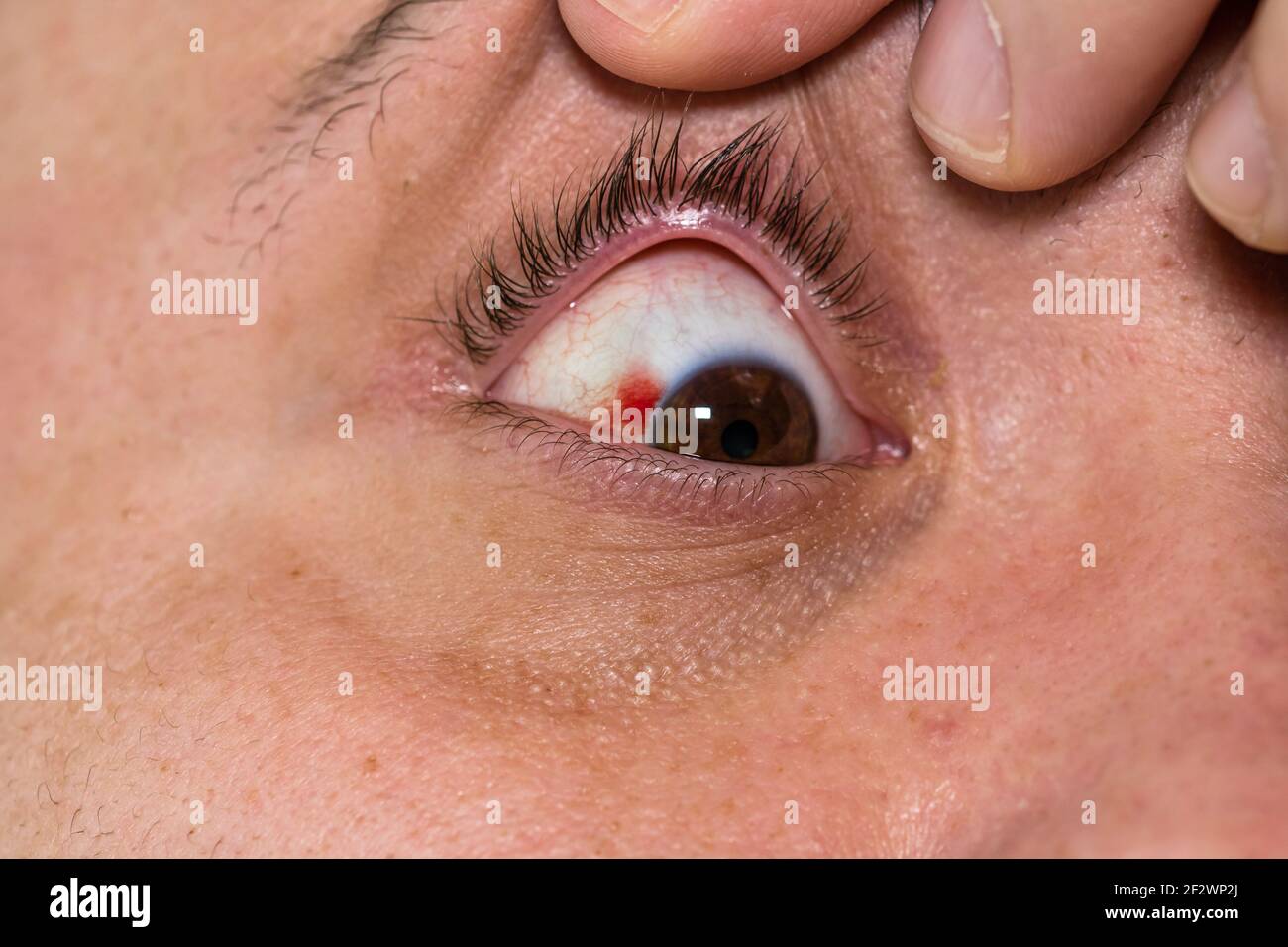 Eye Injury Young Man With Burst Blood Vessel In Eye Fatigue Problems 