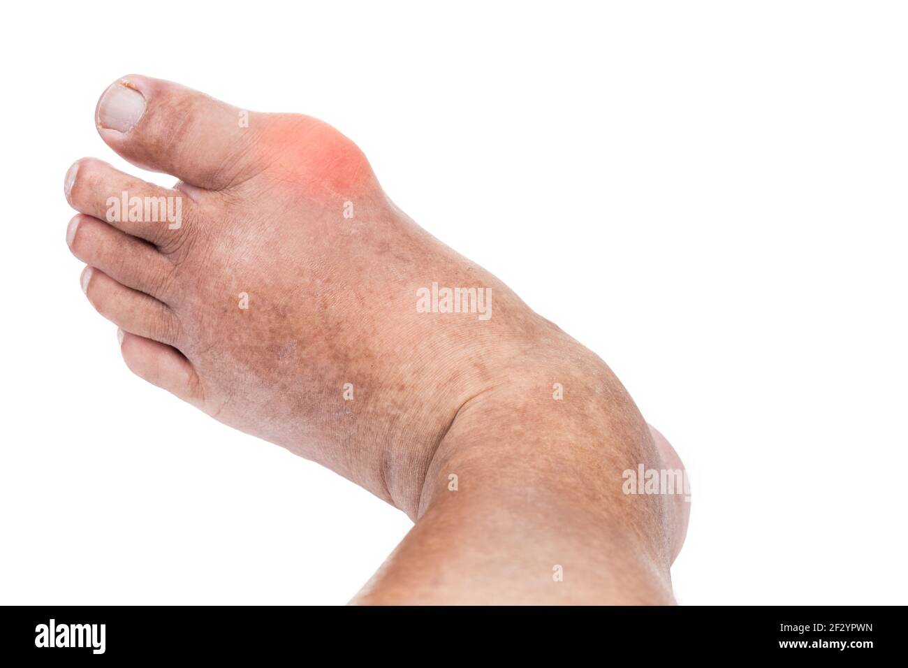 Swollen deformed inflammed toe joint with painful gout Stock Photo