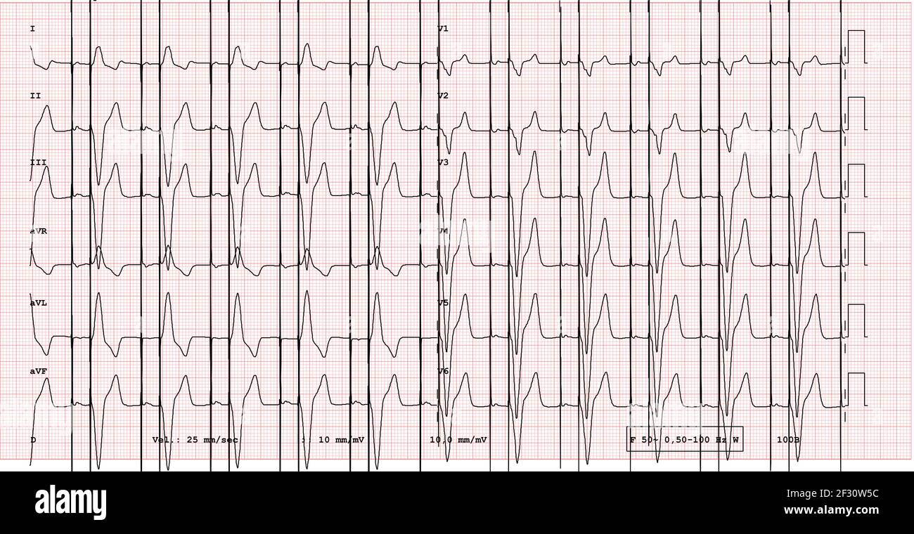 ECG example of a pacemaker 12lead rhythm with pacing peak Stock Photo