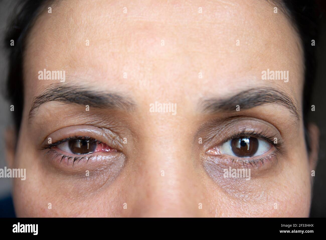 the recovery process of the young woman after eye surgery. Portrait