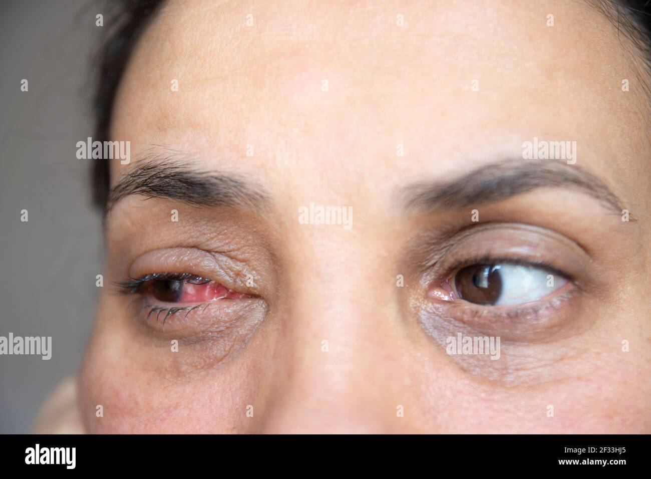 the recovery process of the young woman after eye surgery. Portrait. Close up. Stock Photo