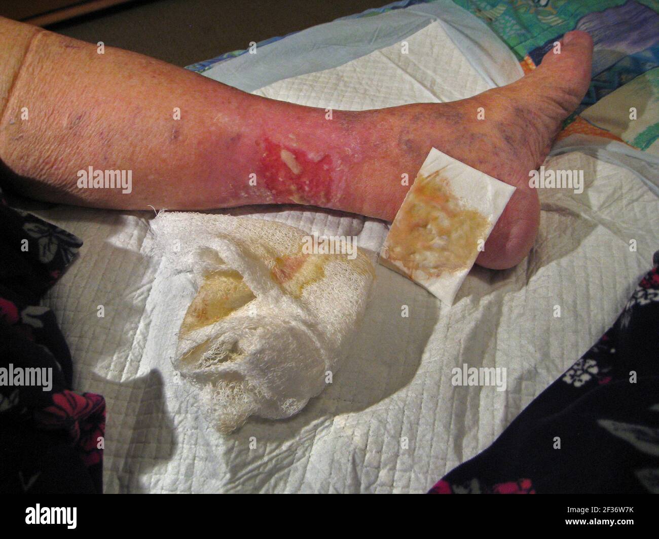 Massive skin inflammation on the lower leg of an elderly Caucasian female is shown after a nonstick pad and cotton wrap bandaging are removed before the dressing is changed at a hospital Wound Center in Florida, USA. Known as "stasis dermatitis," this ugly and painful rash was caused by a buildup of fluid due to poor blood circulation in the lower legs that is common to some older adults, especially women. Symptoms of this medical condition include oozing and crusting open sores (ulcers), redness or other discoloration of the skin, swelling and itching. Healing can take considerable time. Stock Photo