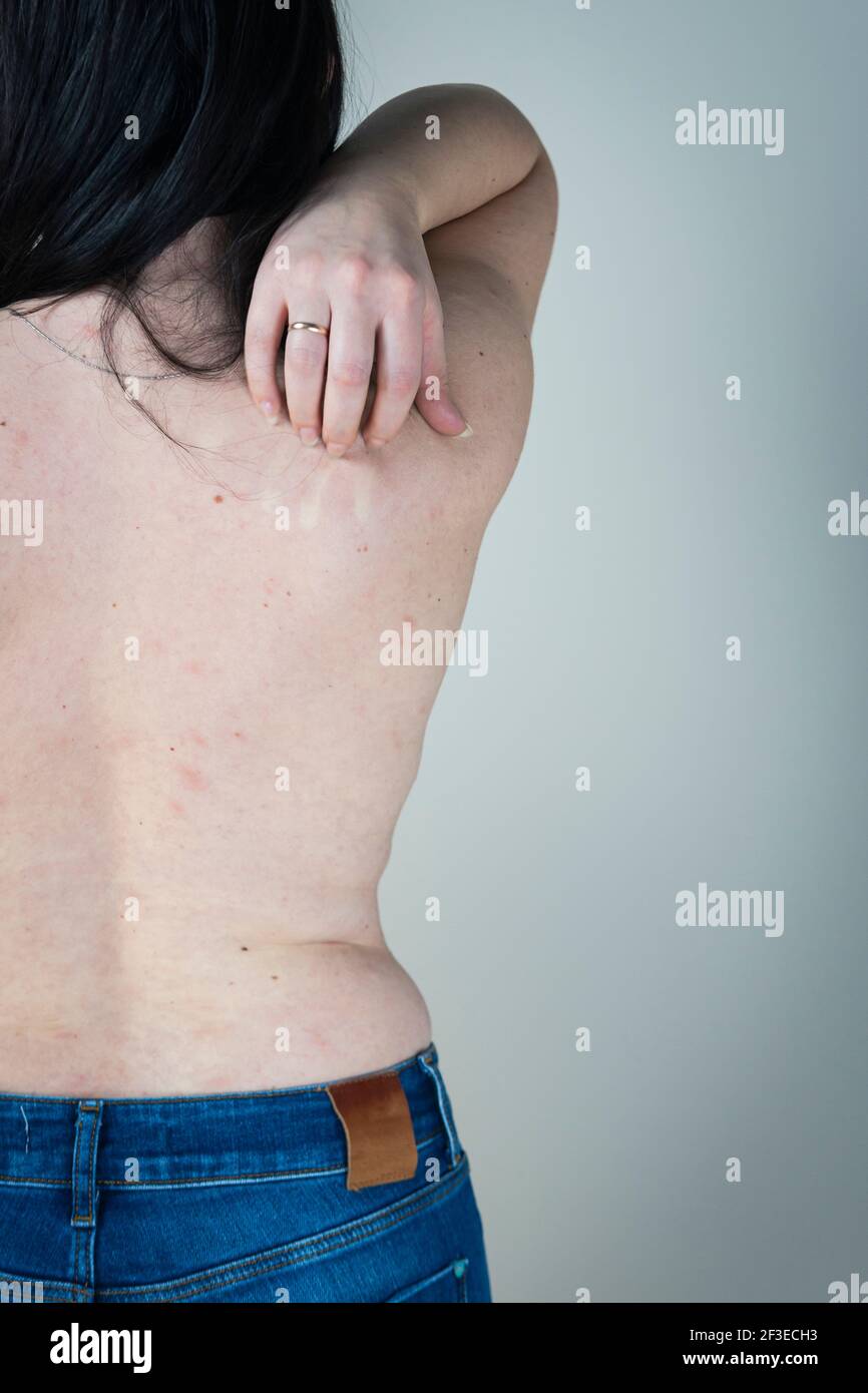 Health problem, skin diseases. Young woman showing her itchy back with allergy  rash urticaria symptoms Stock Photo - Alamy