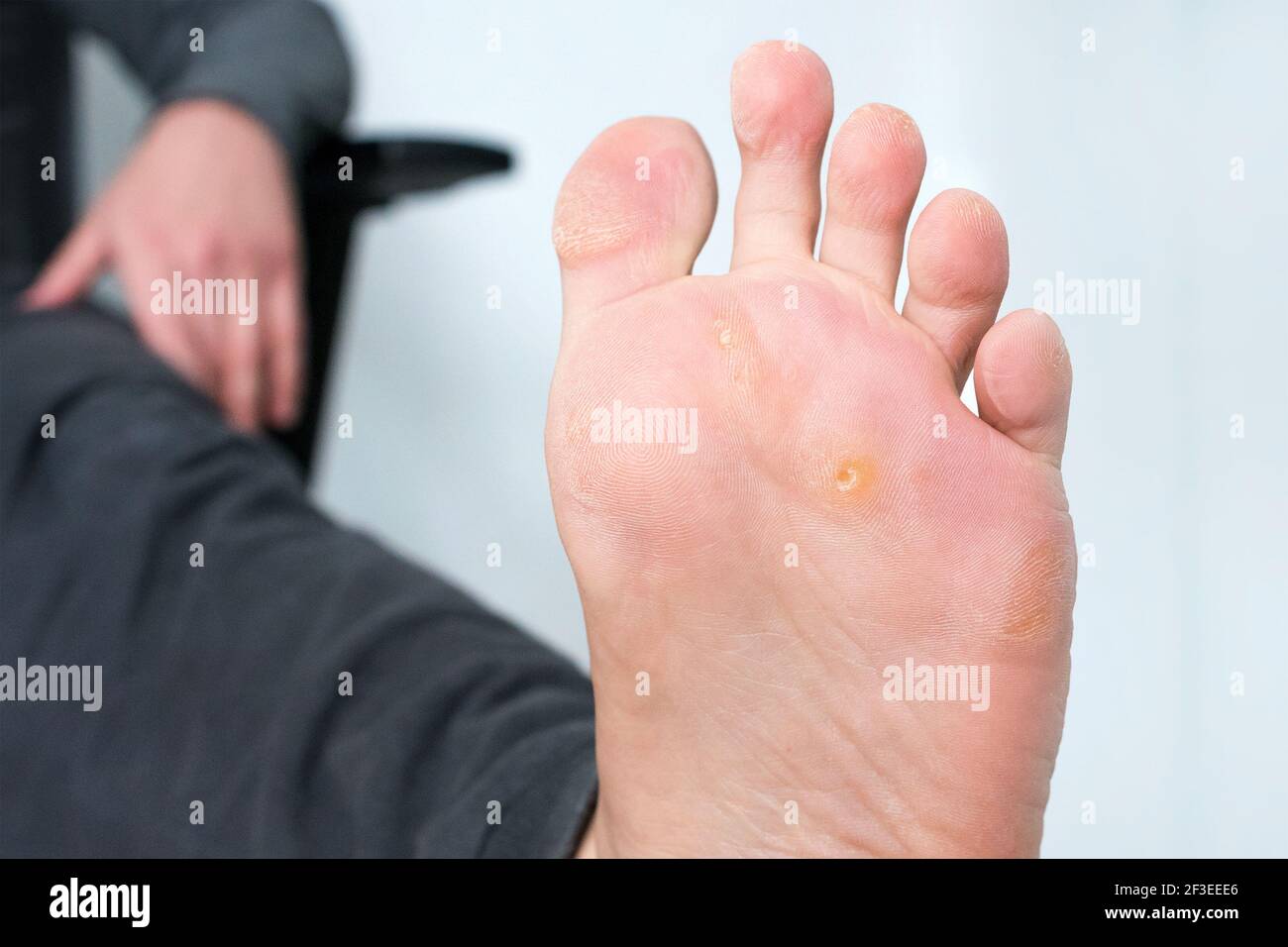 Foot with corns, calluses and dry skin, wart plantar verrucas. Verrucas papilloma callus virus, desease on foot skin. Unhealthy foot leg with corn clo Stock Photo