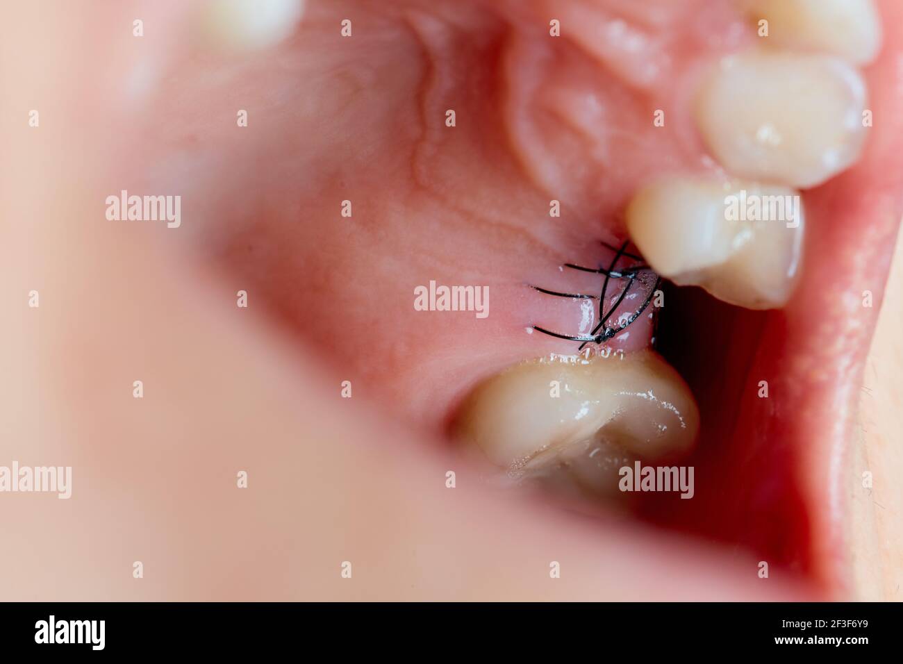 Closeup on suture after dental implant surgery. Stock Photo