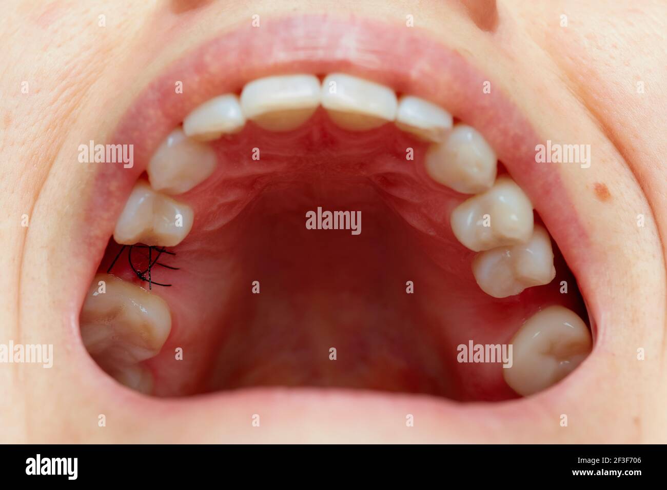 Closeup on suture after dental implant surgery Stock Photo Alamy