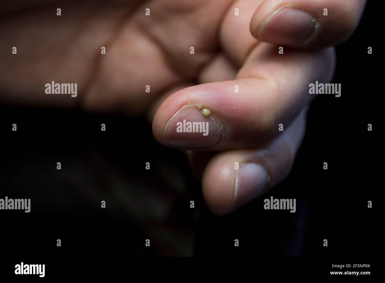 Hang nail infection hi-res stock photography and images - Alamy