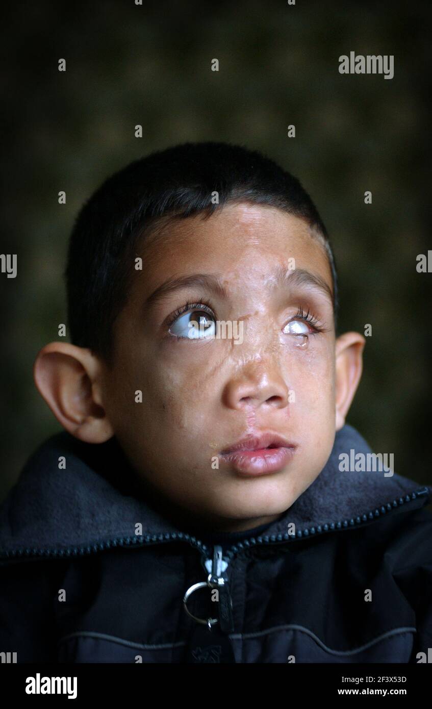 ALI HUSSEIN FROM IRAQ,WAS BADLY HURT DURING THE WAR AND IS IN THE UK FOR FACE RECONSTRUCTION. 10/3/04 PILSTON Stock Photo