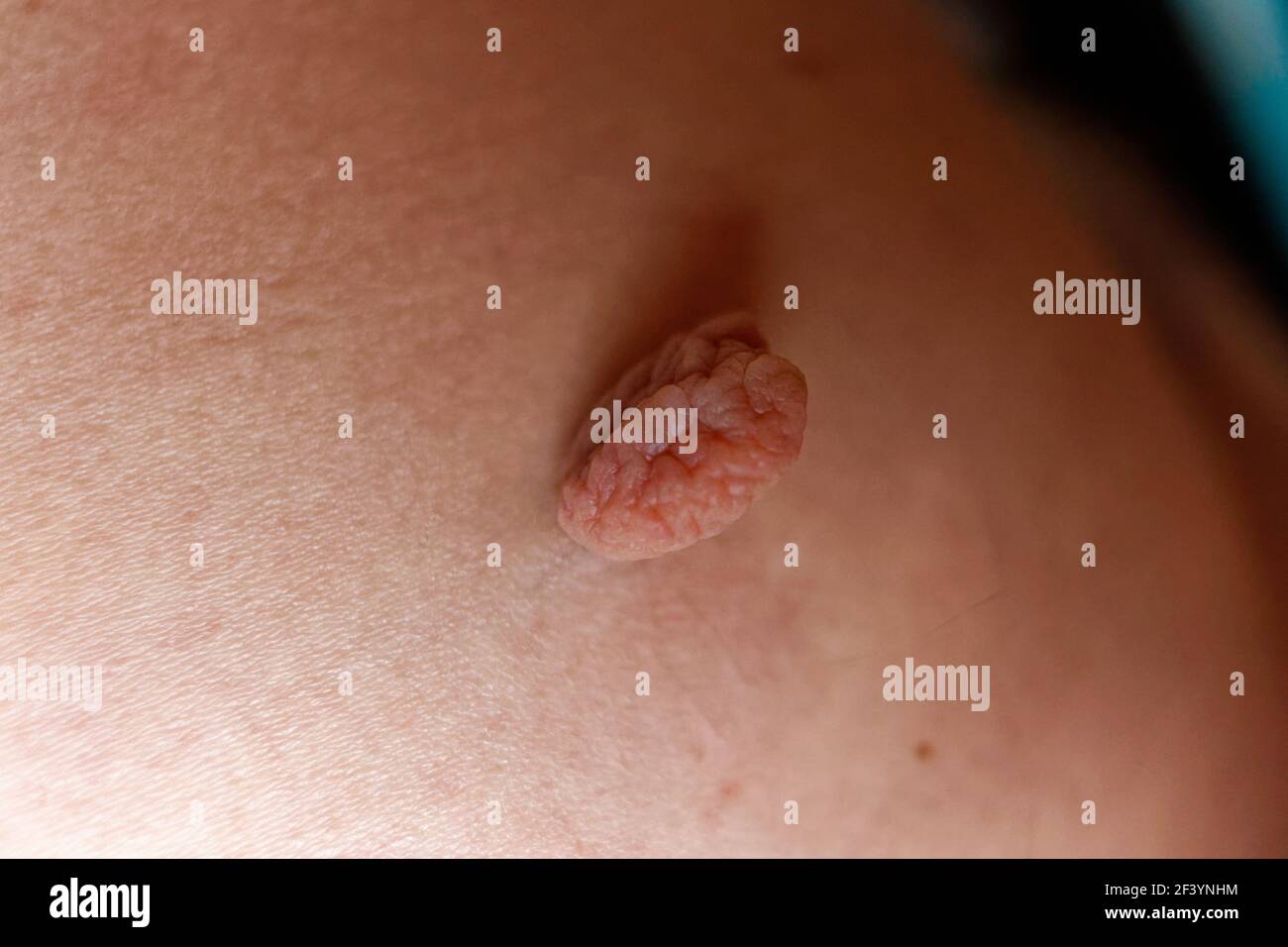 A large fibrolipoma on a skin, a medical condition to be examined Stock  Photo - Alamy