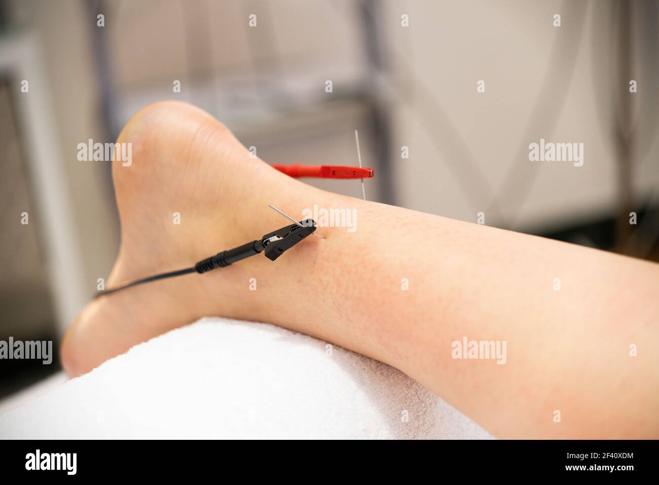 electroacupuncture with the needle connection machine used by the  acupuncturist in men. Electrical stimulation in physiotherapy to the twin  of a young man in the physiotherapy center. Stock Photo