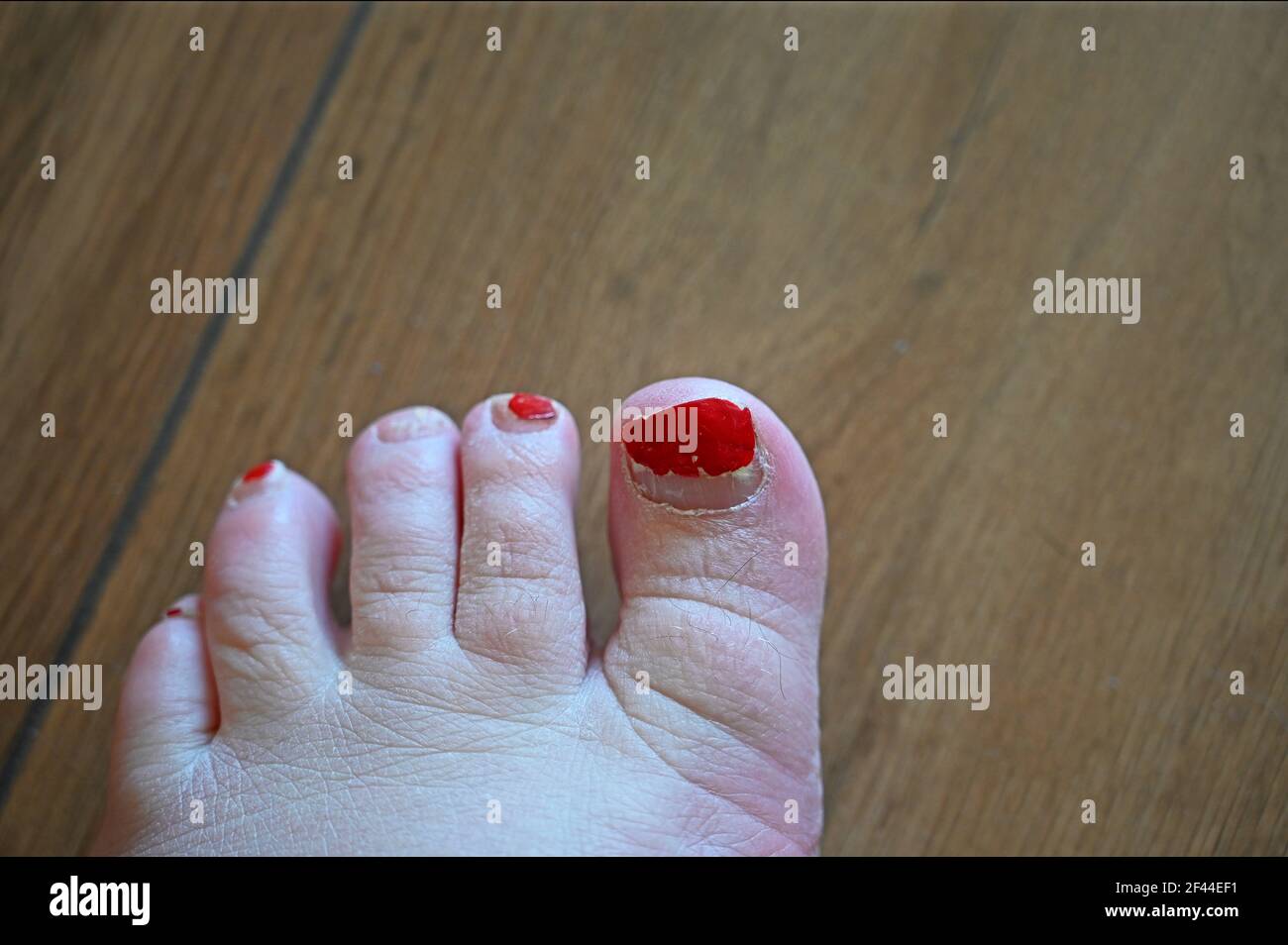 køkken jubilæum Menda City Unkempt toes with selective focus on big toe. Chipped red nail polish, dry skin, overgrown nails, hairy toes Stock Photo - Alamy køkken jubilæum Menda City Unkempt toes with selective focus on big toe. Chipped red nail polish, dry skin, overgrown nails, hairy toes Stock Photo - Alamy