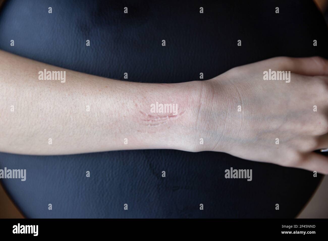 White woman hand with bite marks on black Stock Photo Alamy