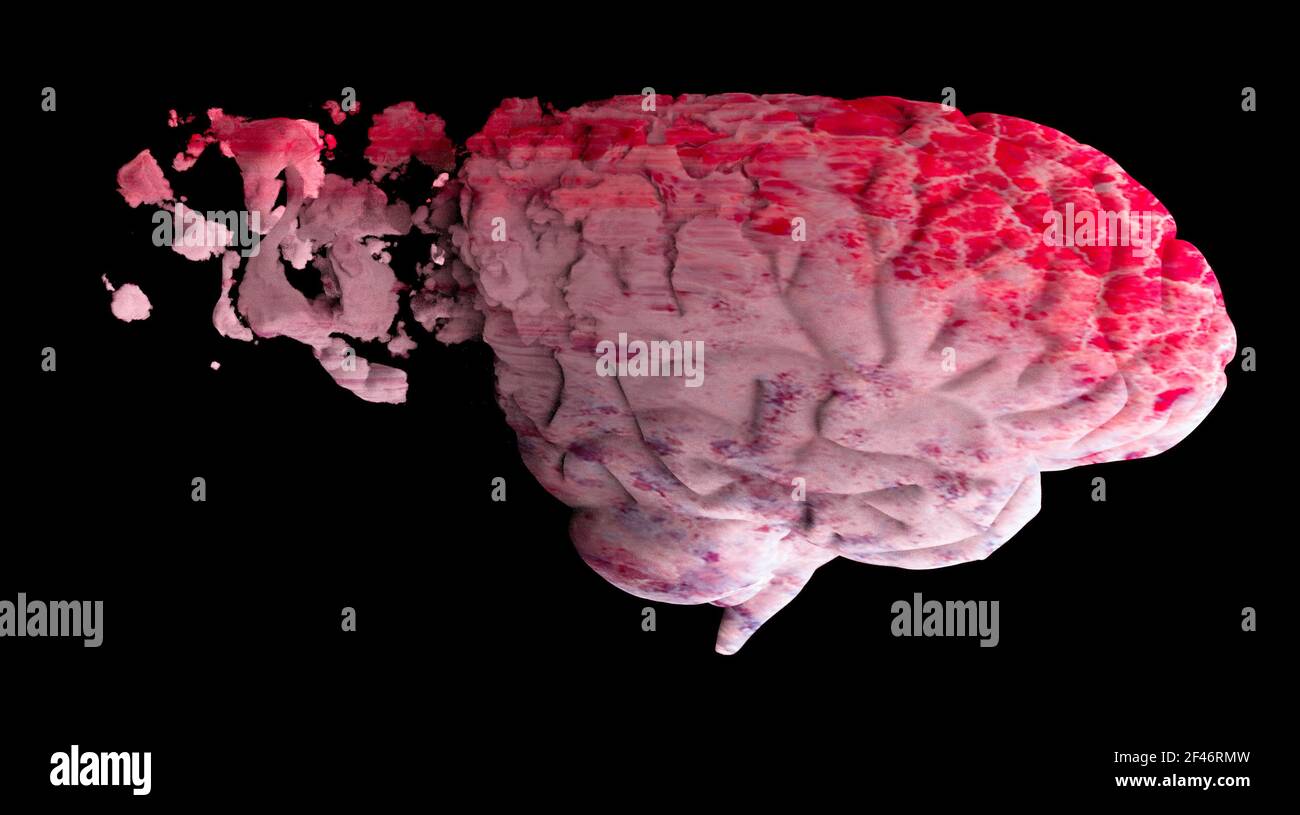 Memory lapses, forgetting things, degenerative disease. Brain problems. Parkinson and alzheimer desease. Mental health. Stroke, synapses and neurnons Stock Photo