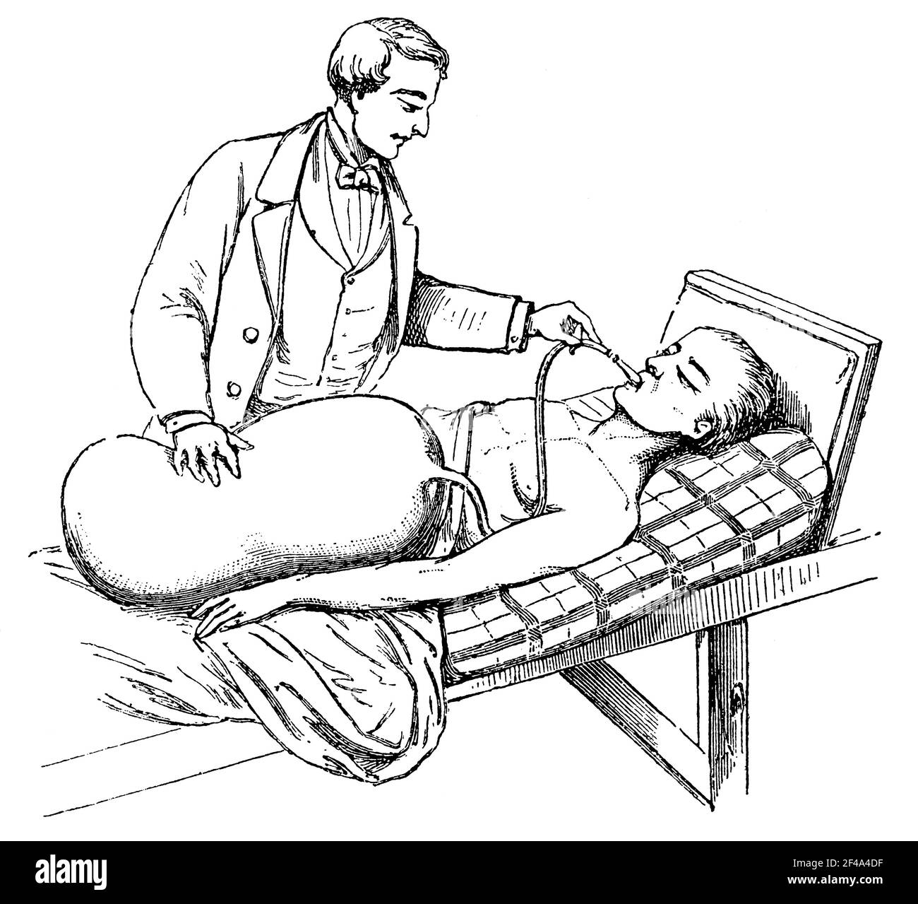 Induction of artificial respiration in the case of attacks of suffocation. Illustration of the 19th century. Germany. White background. Stock Photo