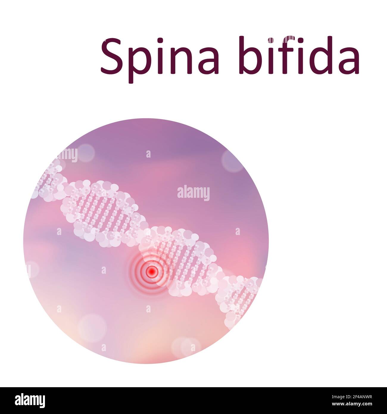 Spina bifida, illustration Stock Photo