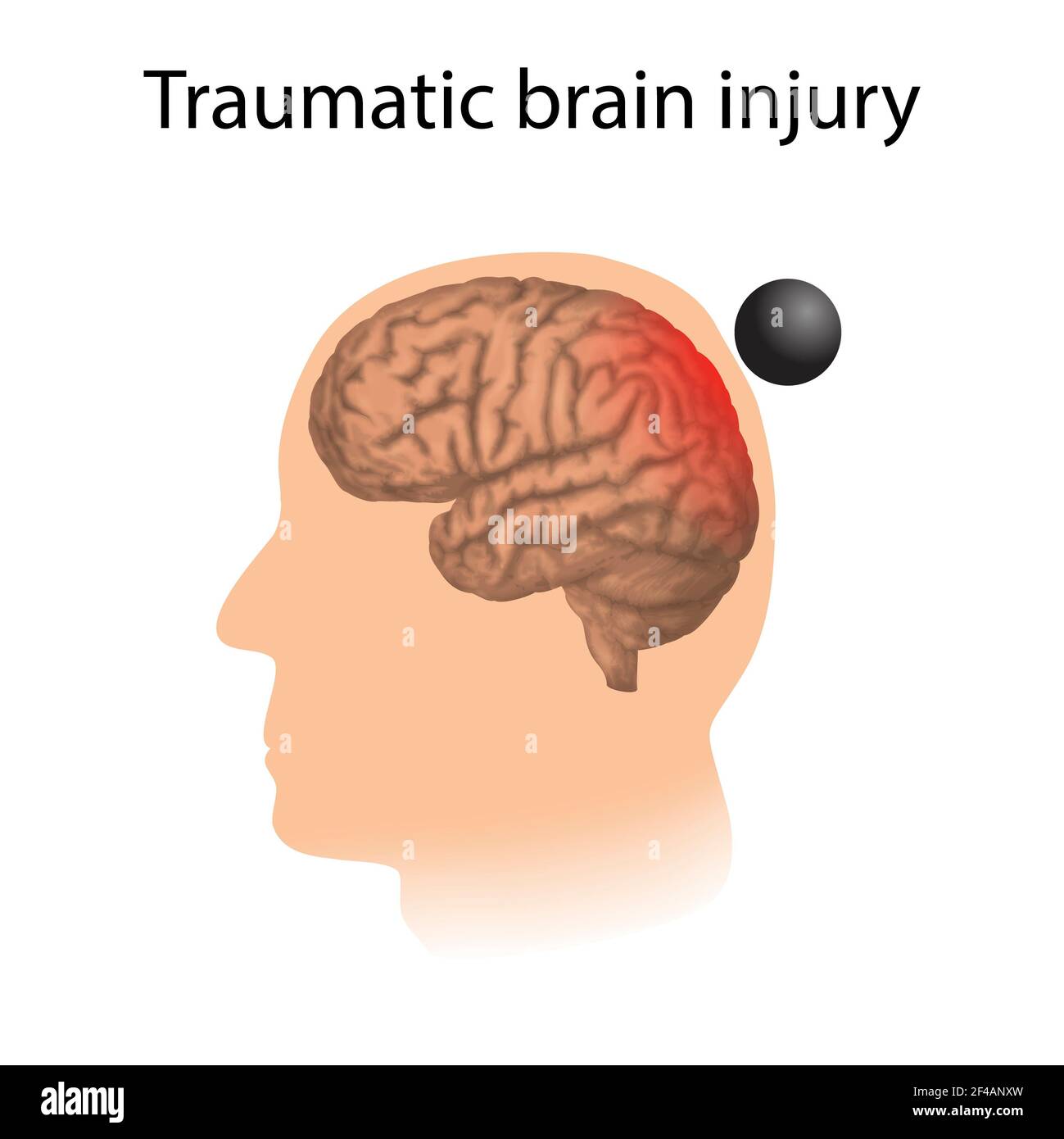 Traumatic brain injury, illustration Stock Photo