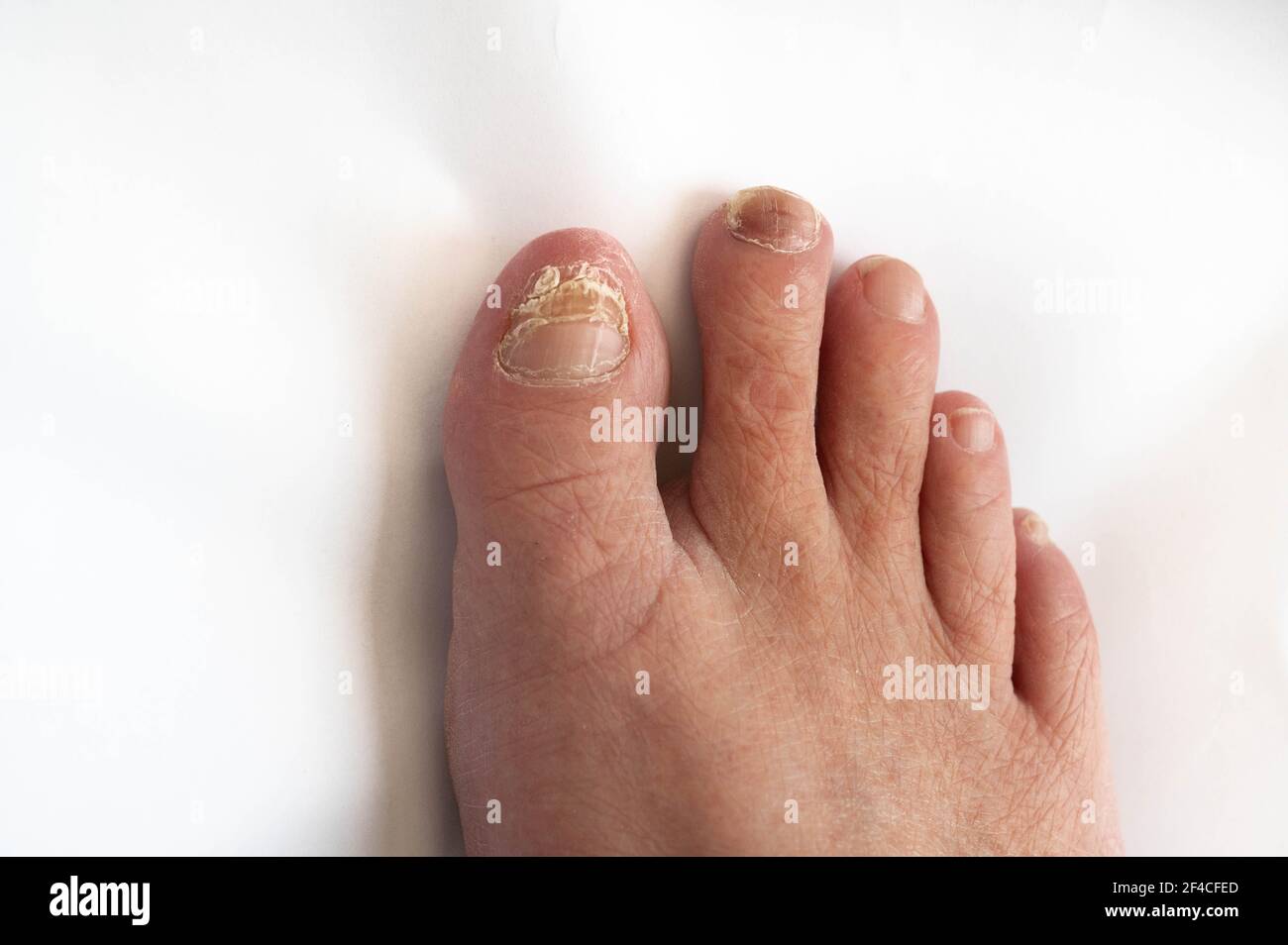 females foot showing new growth of new big toe nail coming through after injury 2F4CFED