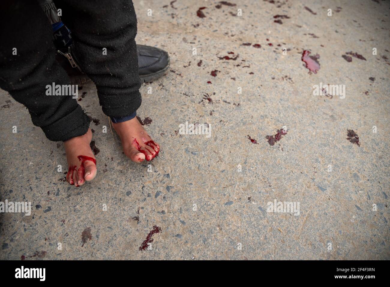 Srinagar, India. 21st Mar, 2021. Blood comes out from the feet of a kid after receiving leech treatment on the bank of Dal lake.On Nowroz 21st March every year traditional health workers in Kashmir use leeches to treat people for itchy, painful lumps that develop on the skin called chilblains acquired during winter. Thousands of patients suffering from various skin problems receive leech treatment at Hazratbal in Srinagar. Credit: SOPA Images Limited/Alamy Live News Stock Photo