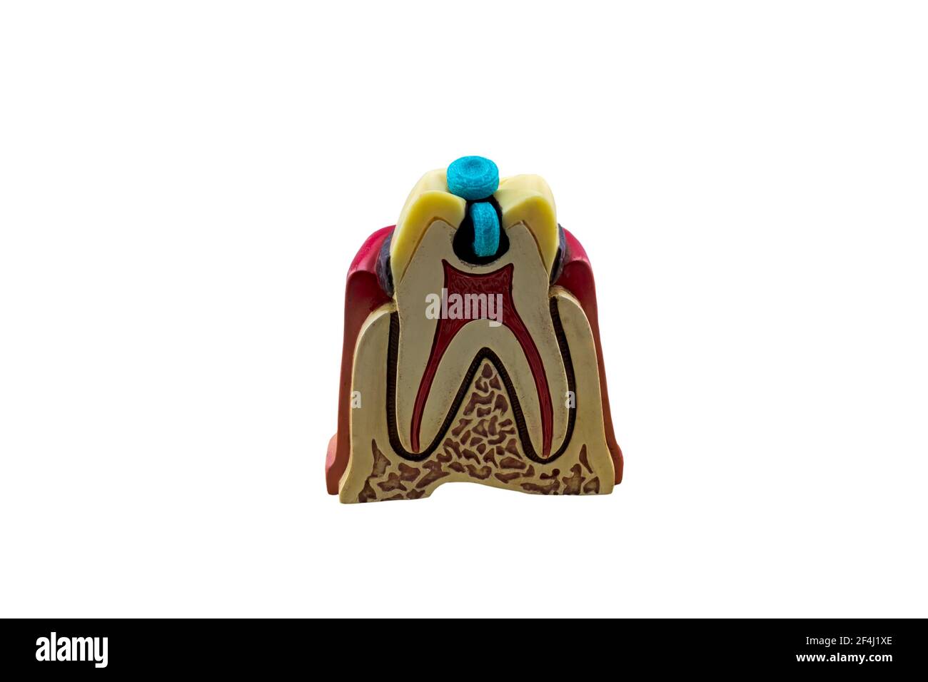 Big tooth dental caries model and candy on wooden isolated on white