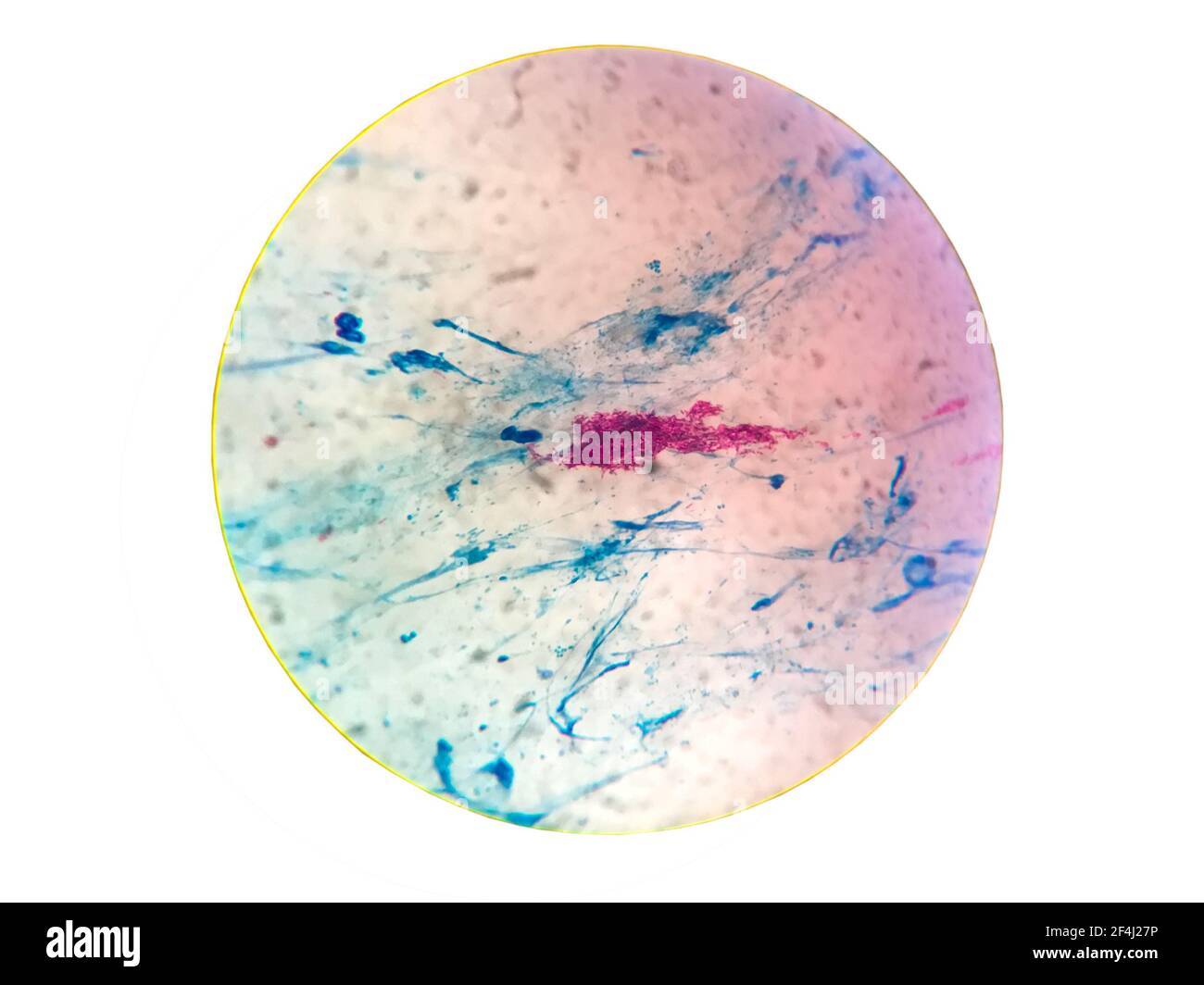 Close up gram stain test showing bacteria cells of Tuberculosis bacteria gram positive  on sputum isolated on white background and noise .Saved with c Stock Photo