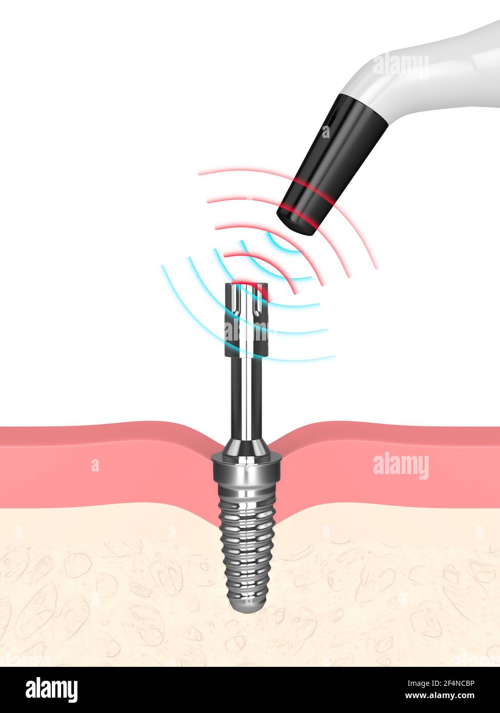 3d render of osseointegration monitoring device checking dental implant