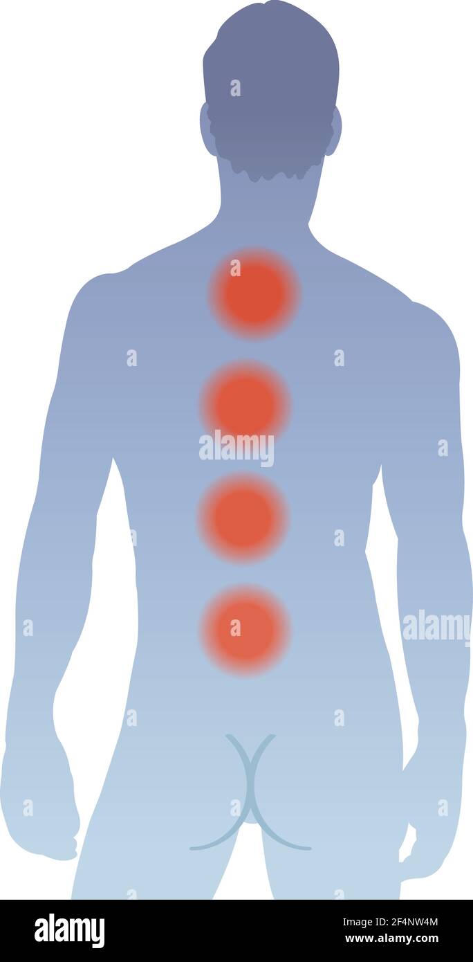 Illustration shows the main areas of pain on the back of man, caused by multiple myeloma. Stock Vector
