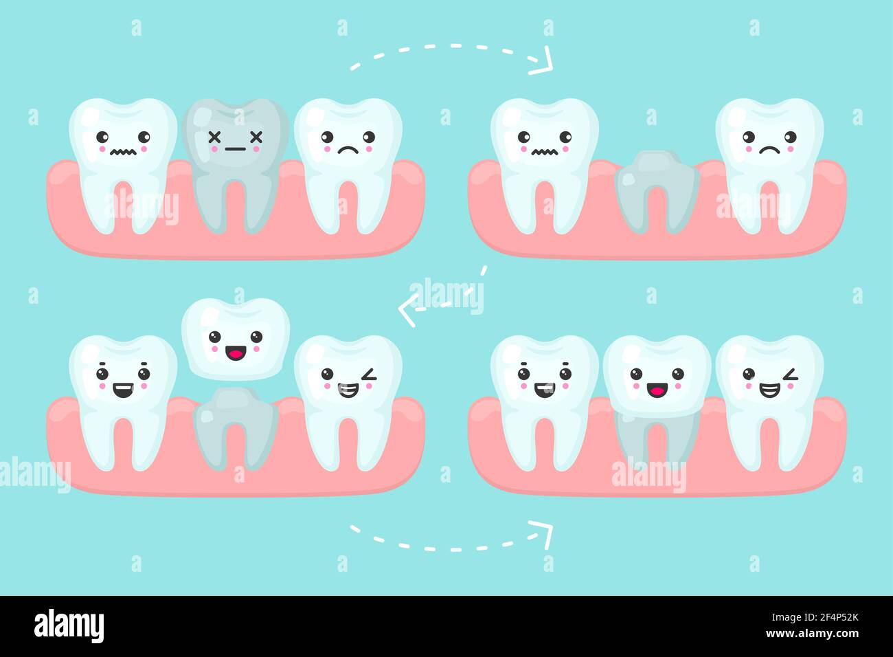 Dental crown setting, tooth stomatology vector concept illustration ...