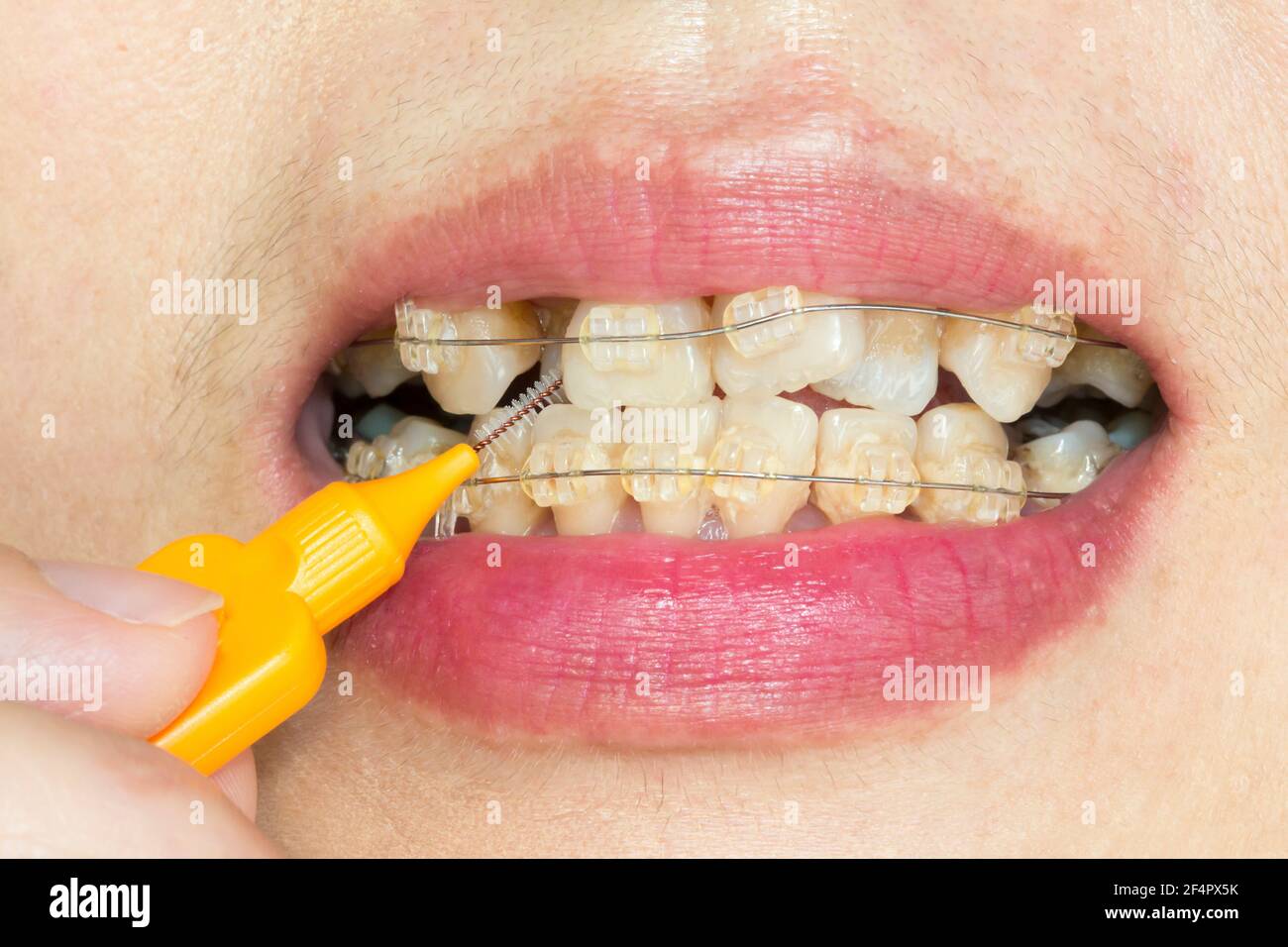 Close up crooked teeth with braces, interdental brushing Stock Photo
