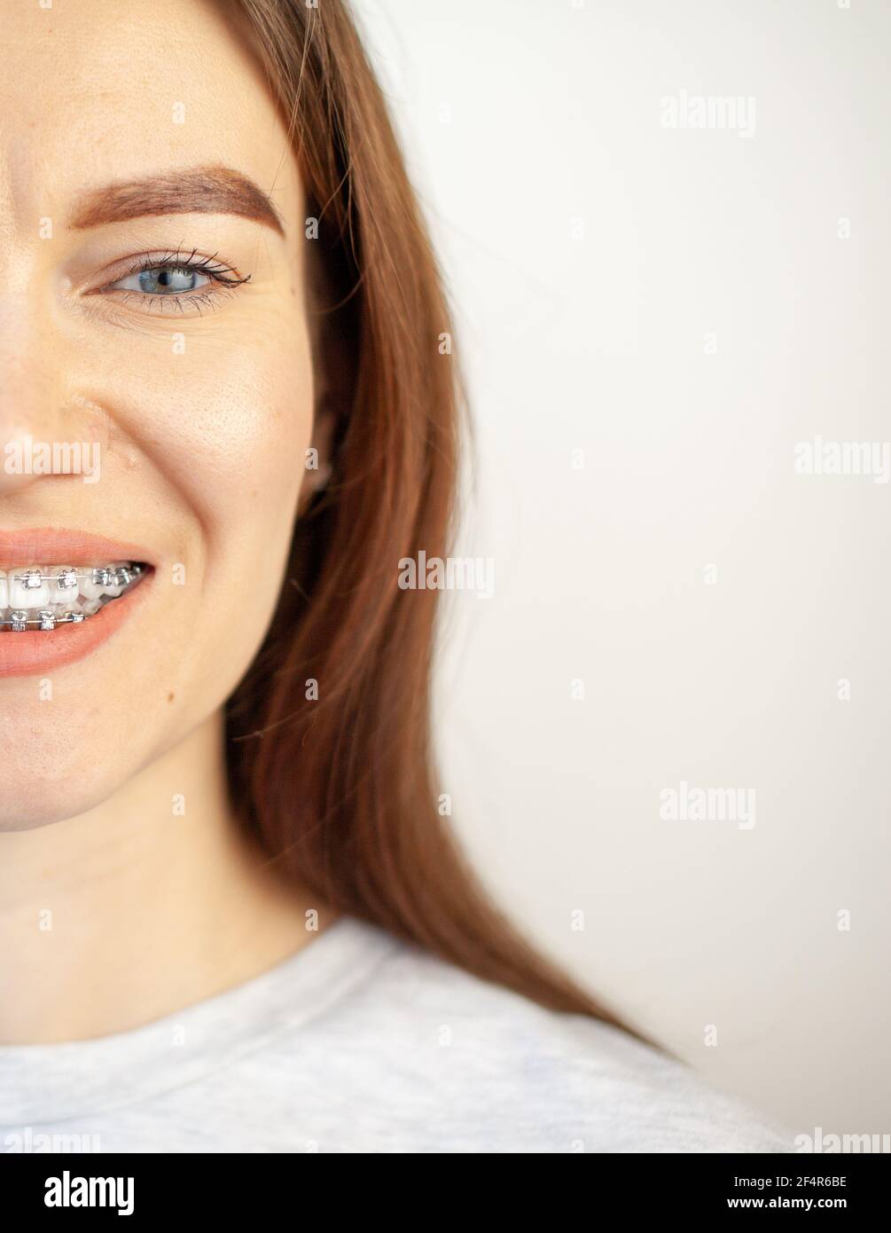 The smile of a young girl with braces on her white teeth. Teeth