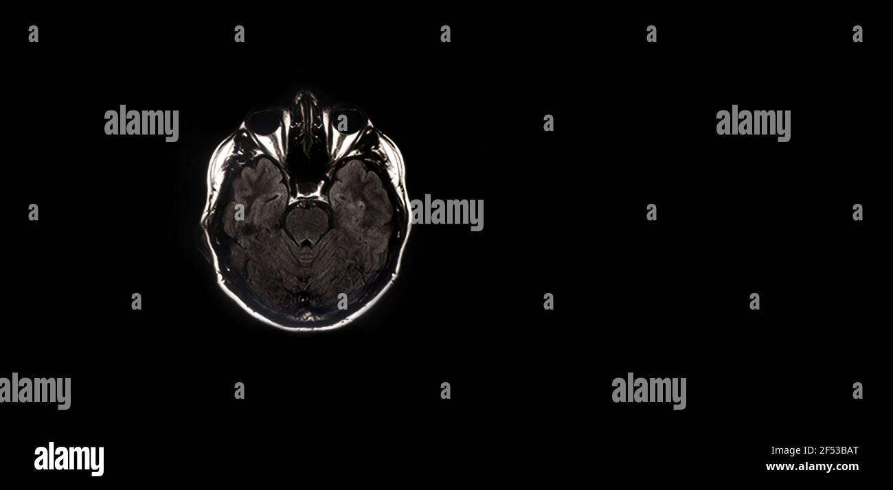Magnetic resonance image (MRI) of normal brain, panoramic mock-up Stock Photo