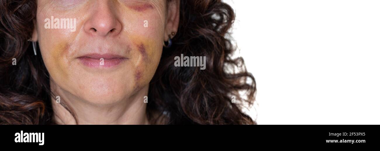 Woman smiling with bruises in the face with text space Stock Photo