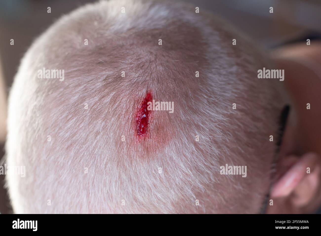 Injury to the scalp. Blood leaks from a chopped wound on the head of a blond man due to falling metal reinforcement. Non-observance of safety .precaut Stock Photo