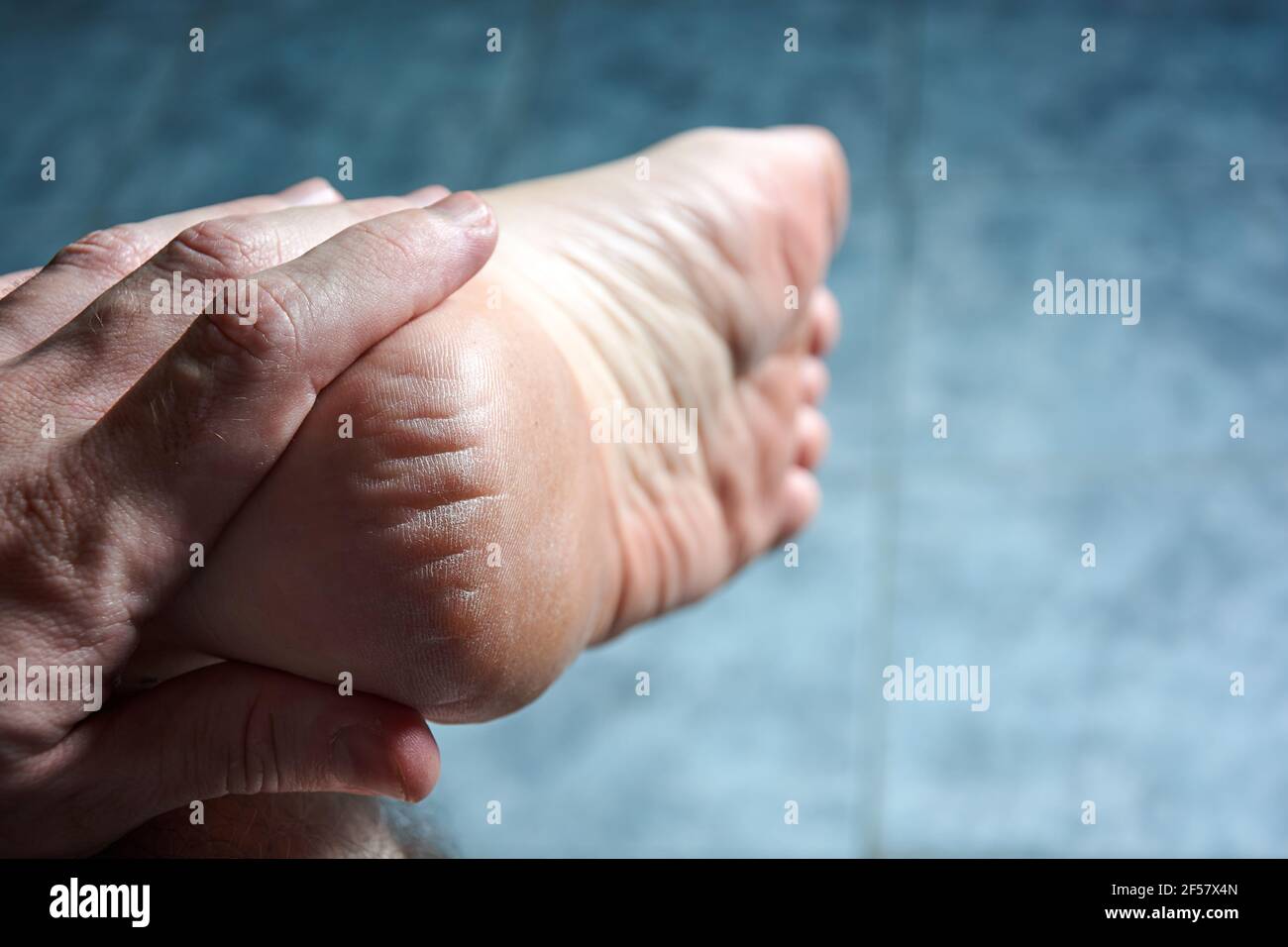 Young caucasian man's hand holding left foot showing cracked heel. Bad skin covered with cracks. Concept of feet care and body health. Stock Photo
